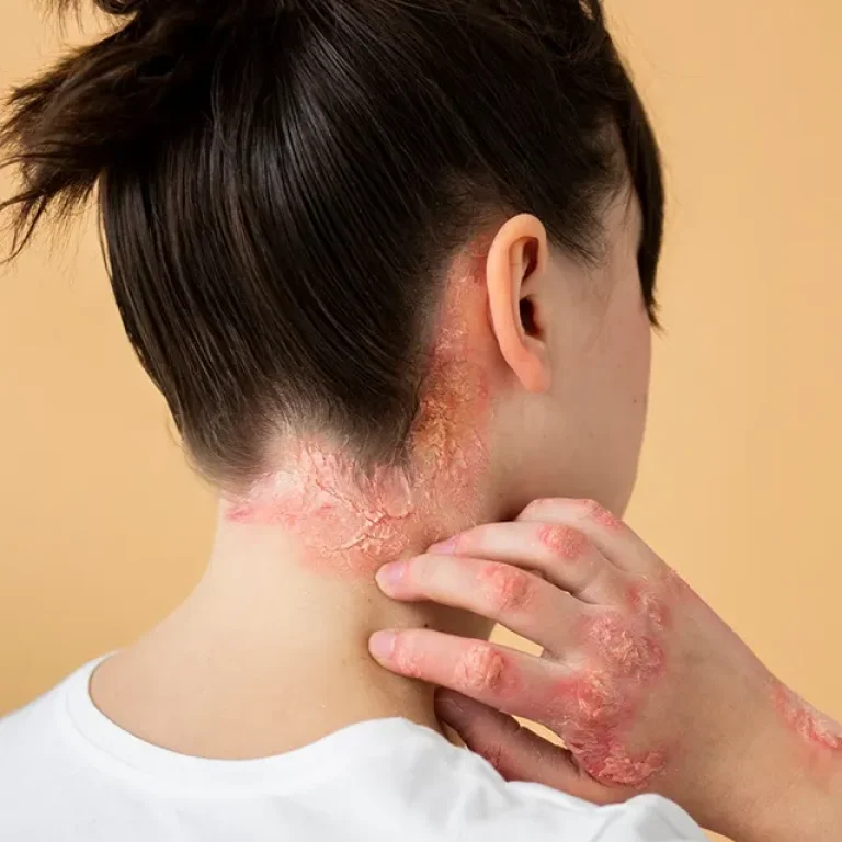 Psoriasis-IMG1