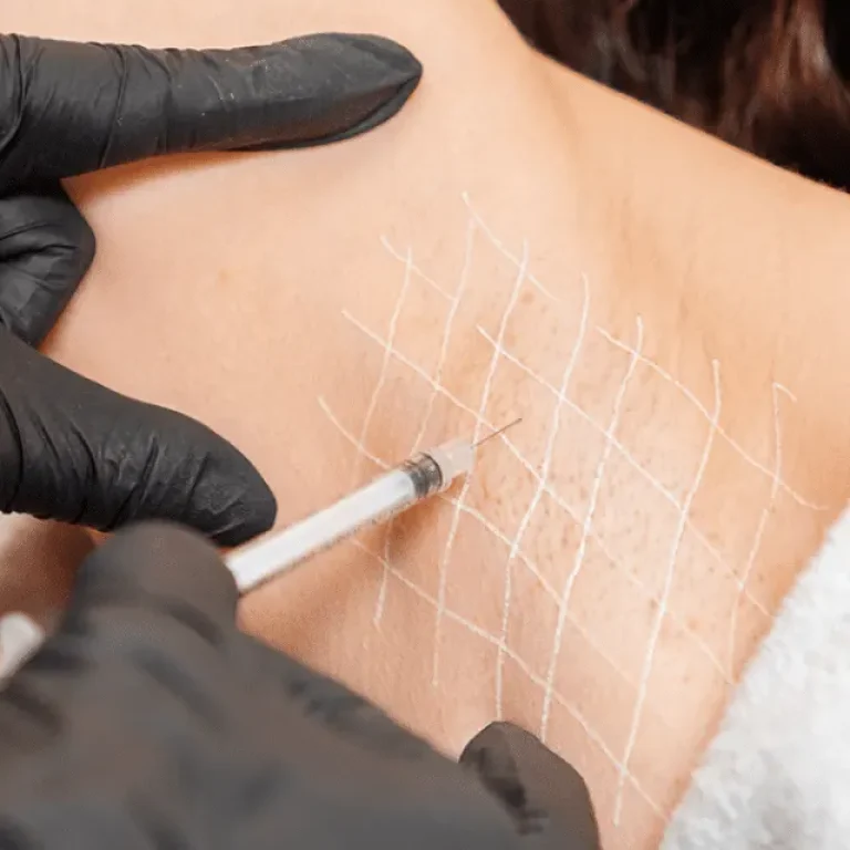 hyperhidrosis-treatment-